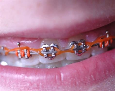 power chain braces repair.